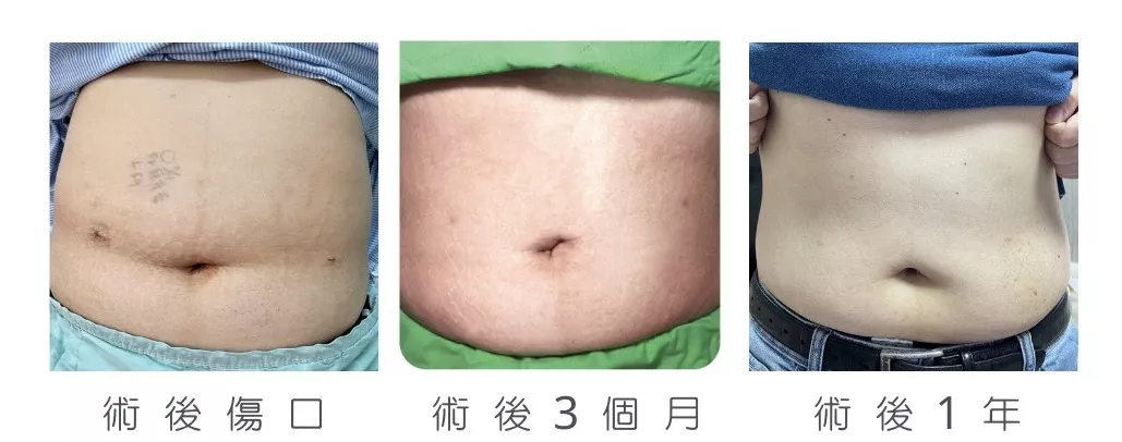 減重手術後傷口恢復圖