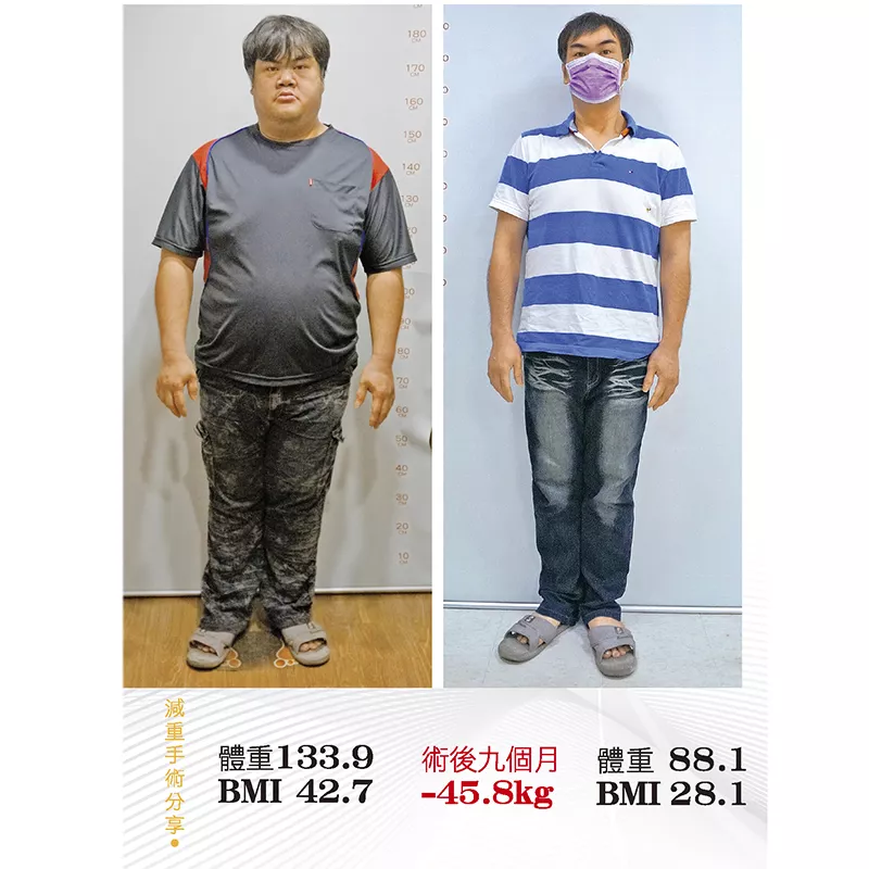 減重手術案例分享 凱