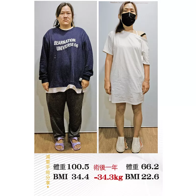 減重手術案例分享 祐