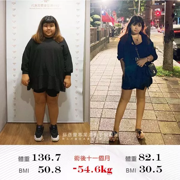 減重手術案例分享 柔
