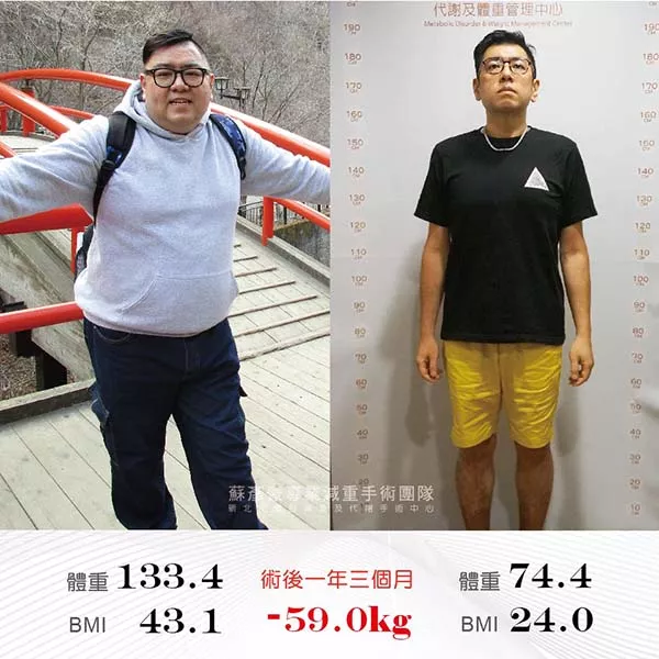 減重手術案例分享 育銚