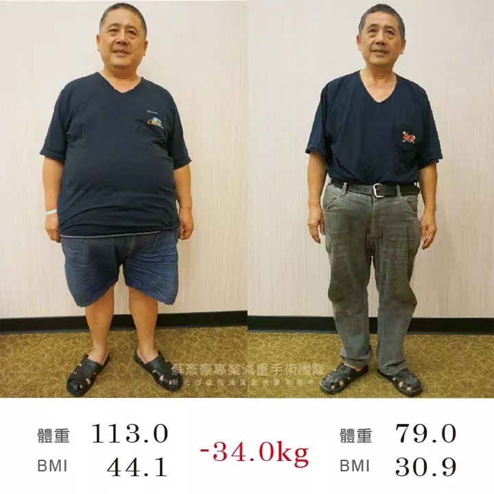 減重手術案例分享 明增
