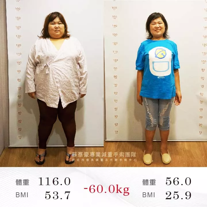 減重手術案例分享 安妤