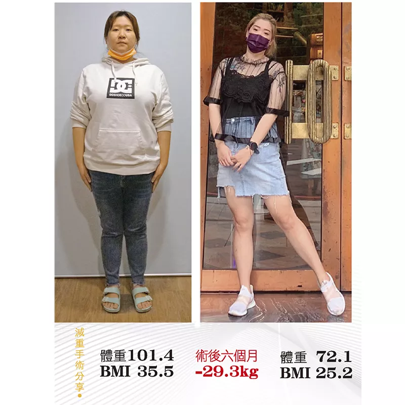 減重手術案例分享 庭