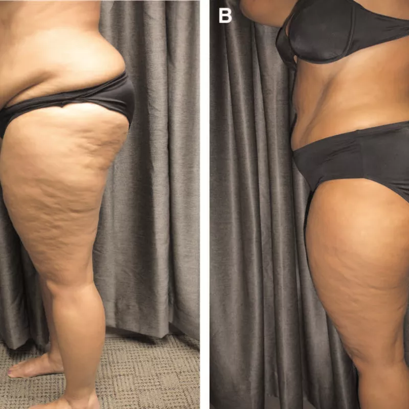 Emerald綠寶石雷射減脂-Obesity before_after.jpg