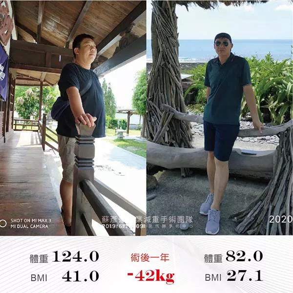 減重手術案例分享 國宥