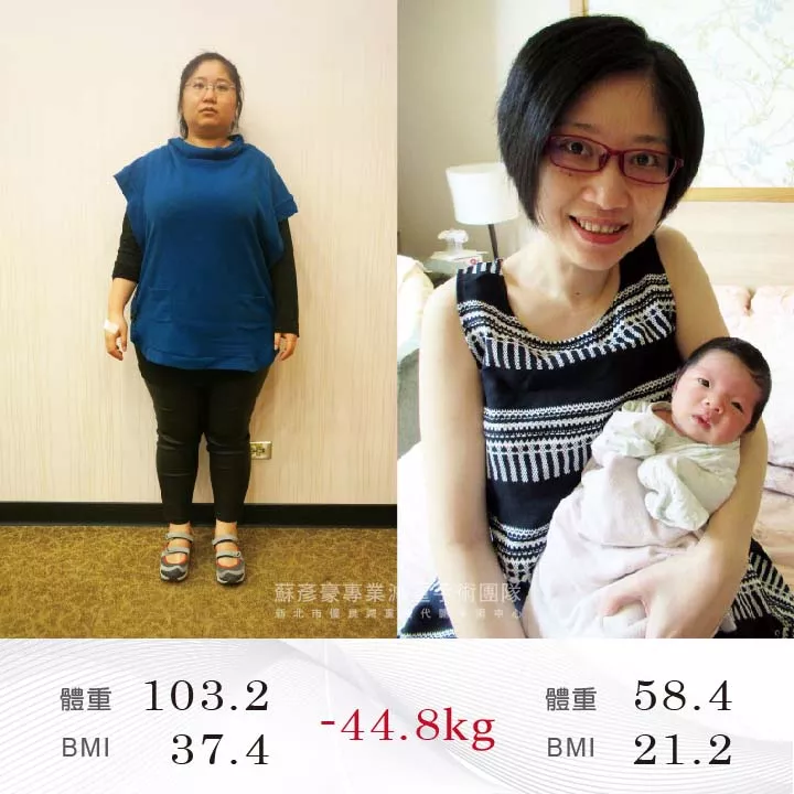 減重手術成功案例分享