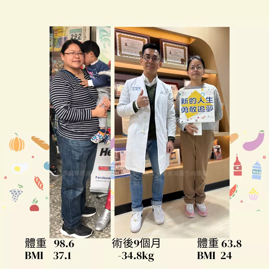 減重手術分享 埕安
