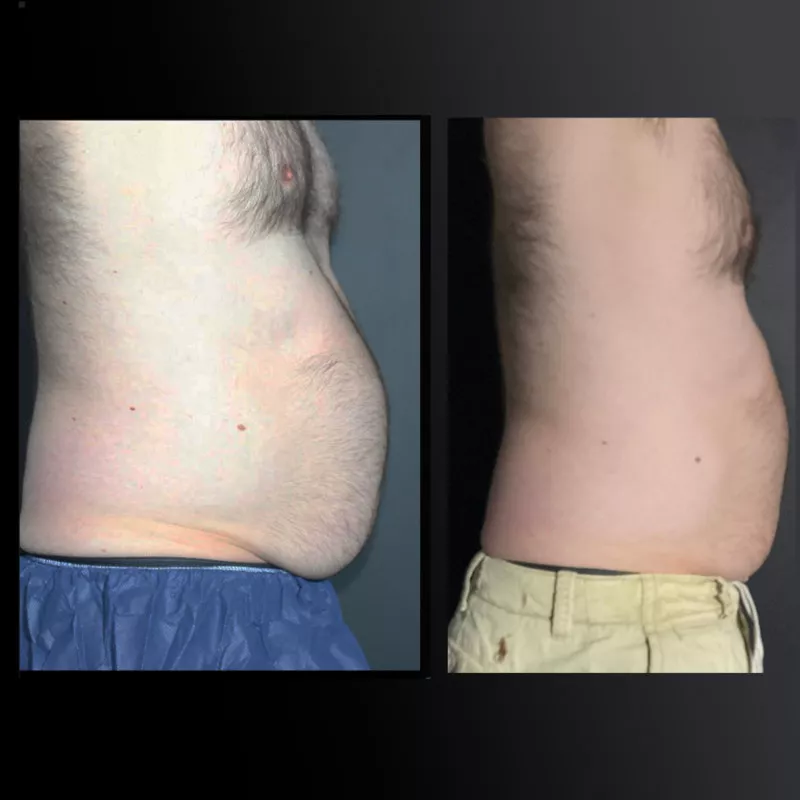 Emerald綠寶石雷射減脂-Male Side B&A.jpg