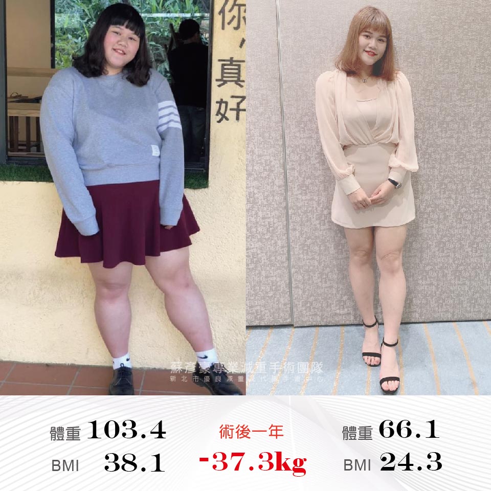 109姿穎_雙和醫院_代謝及體重管理中心_術友感言