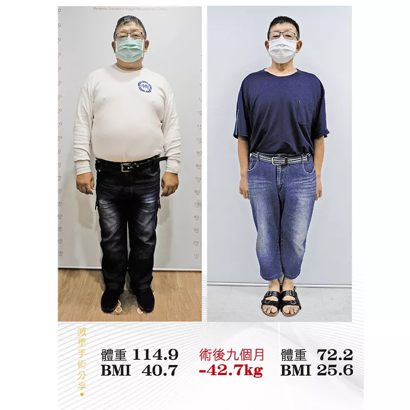 減重手術案例分享 興斌