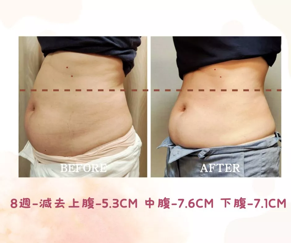 Zerona 光雕減脂超乎預期
