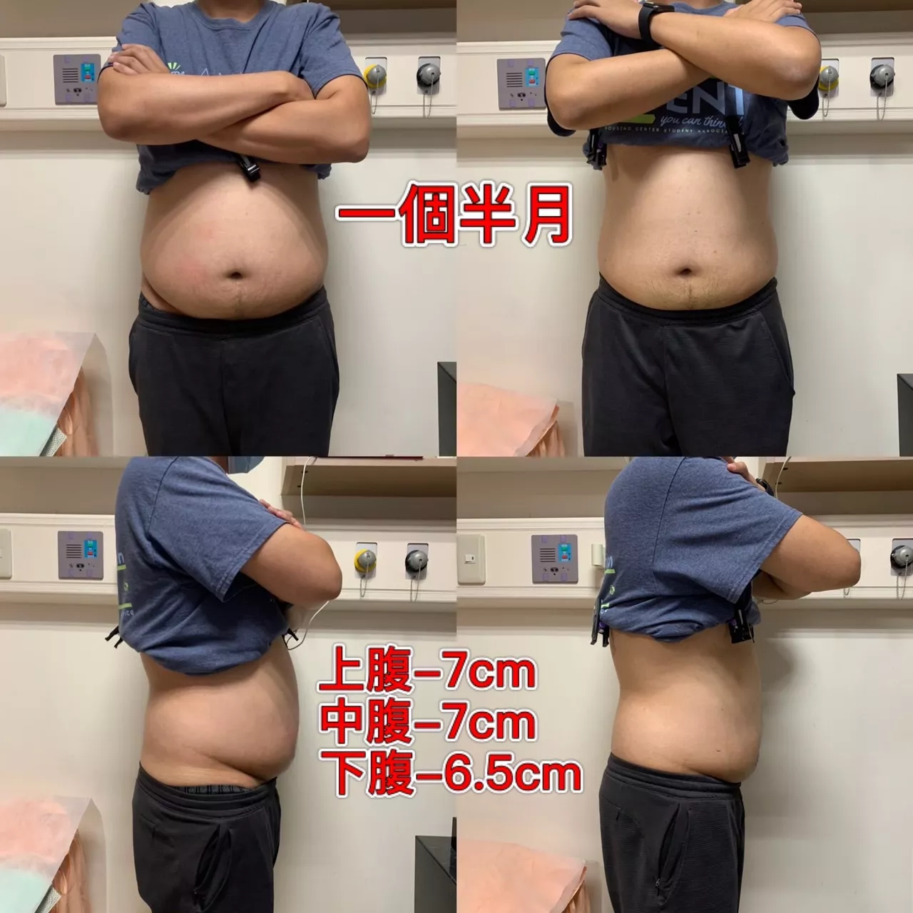 Zerona 光雕減脂45天