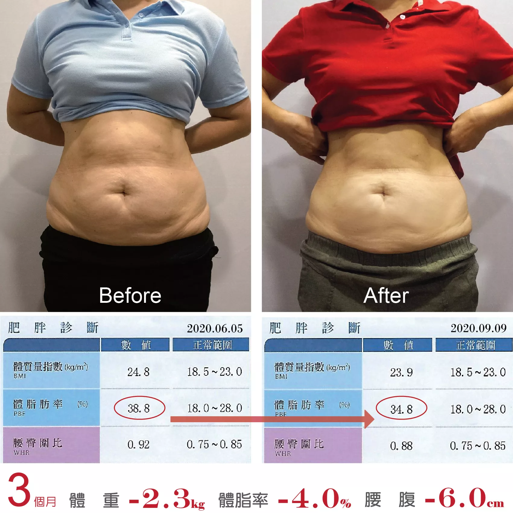 Zerona 光雕減脂就像做SPA