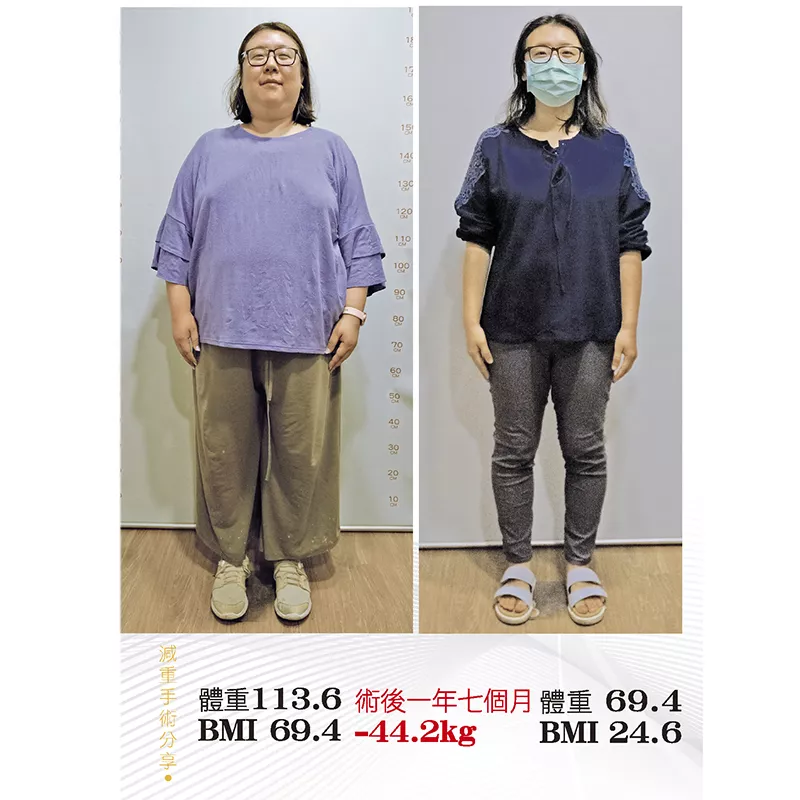 減重手術案例分享 潔
