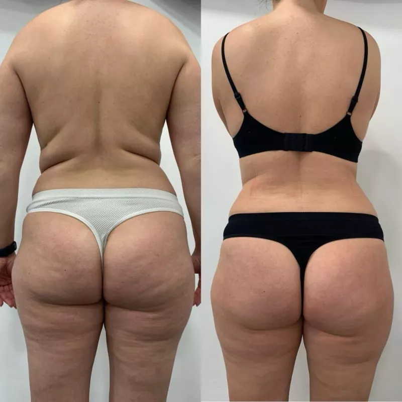 Emerald綠寶石雷射減脂-Back_5 treatments.jpg