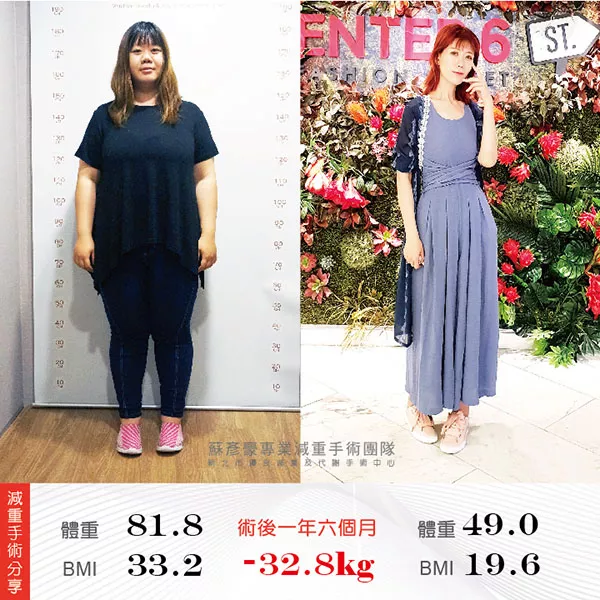 減重手術案例分享 美妗