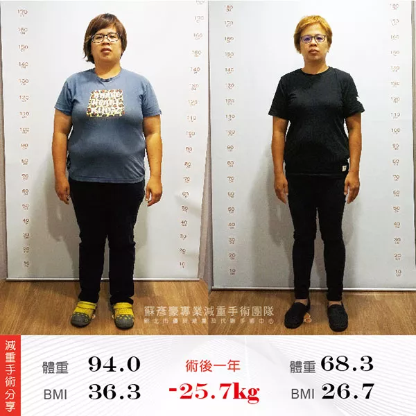 減重手術案例分享 怡君