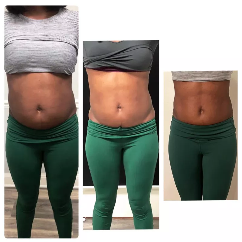 Emerald綠寶石雷射減脂-theconnexusclinic_8 treatments.jpg