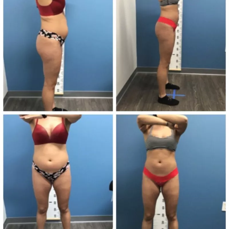 Emerald綠寶石雷射減脂-Before & Afters Younger Female.jpg