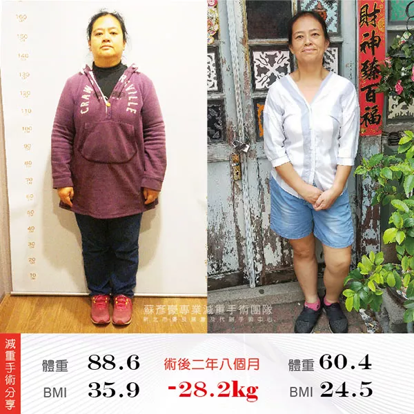 減重手術案例分享 湘惠