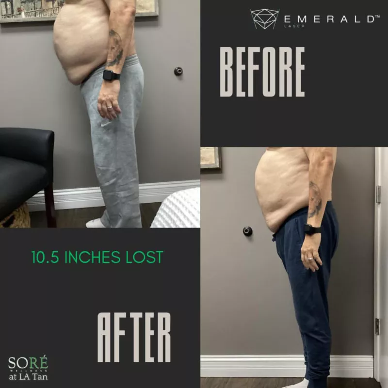 Emerald綠寶石雷射減脂-sorewellness.at.latan_2.jpg