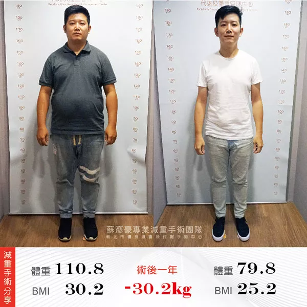 減重手術案例分享 貫哲