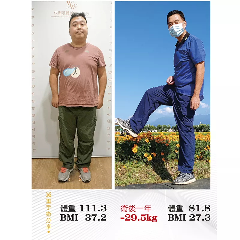 減重手術案例分享 南