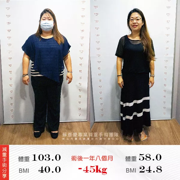 減重手術案例分享 麗美