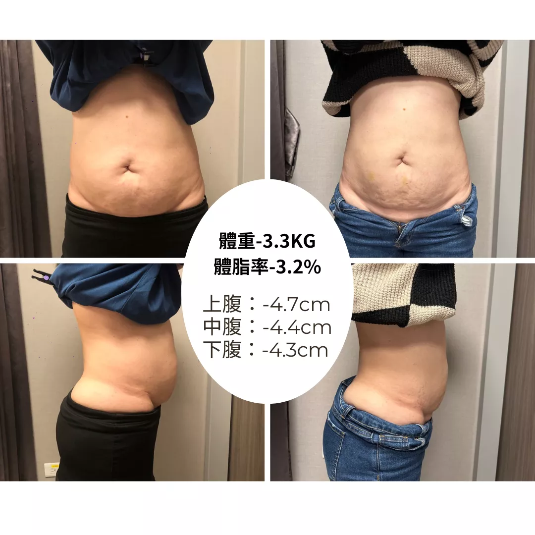 Zerona 光雕減脂超乎預期