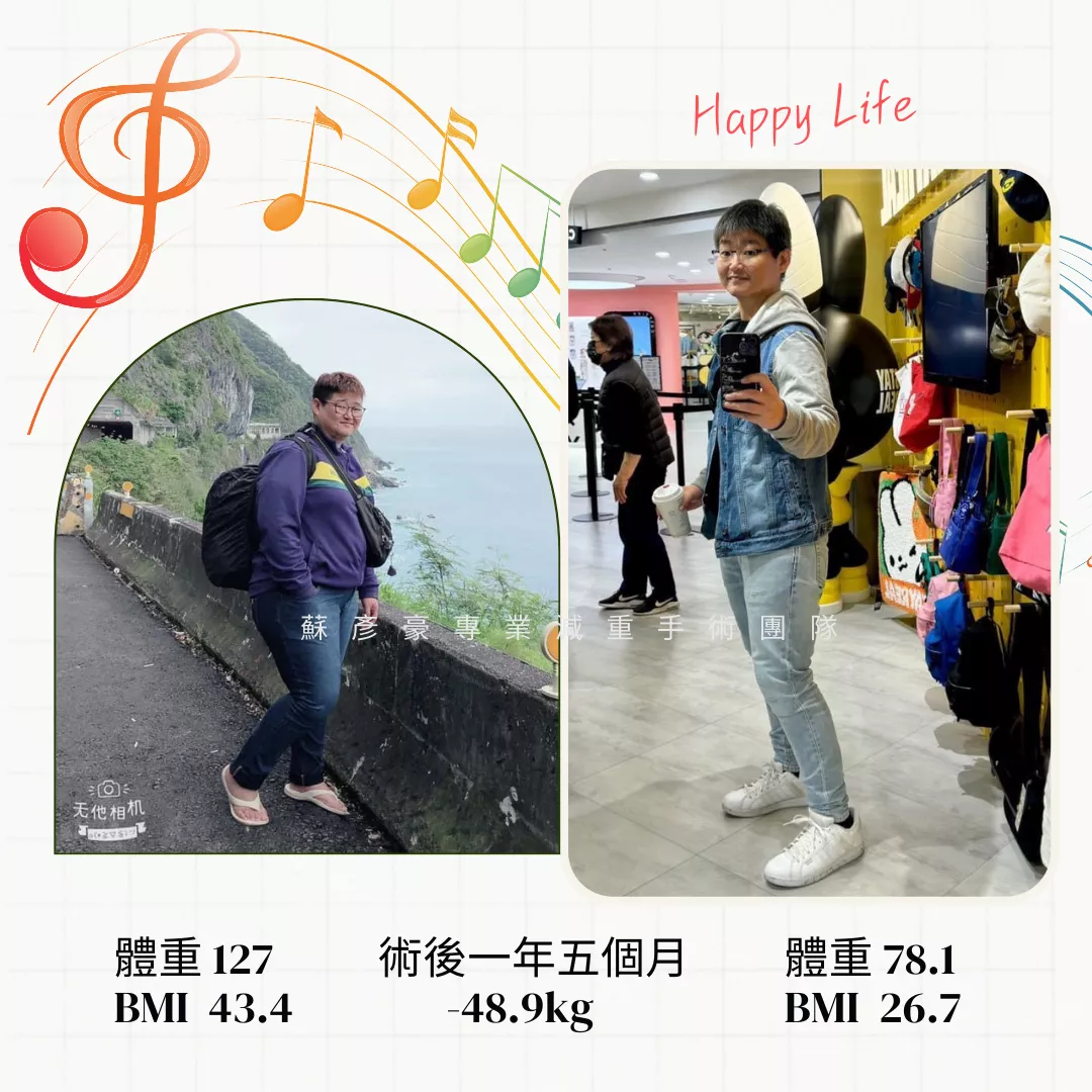 減重手術案例分享 伶軒