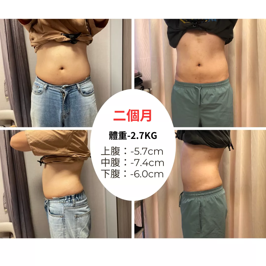 Zerona 光雕減脂超乎預期