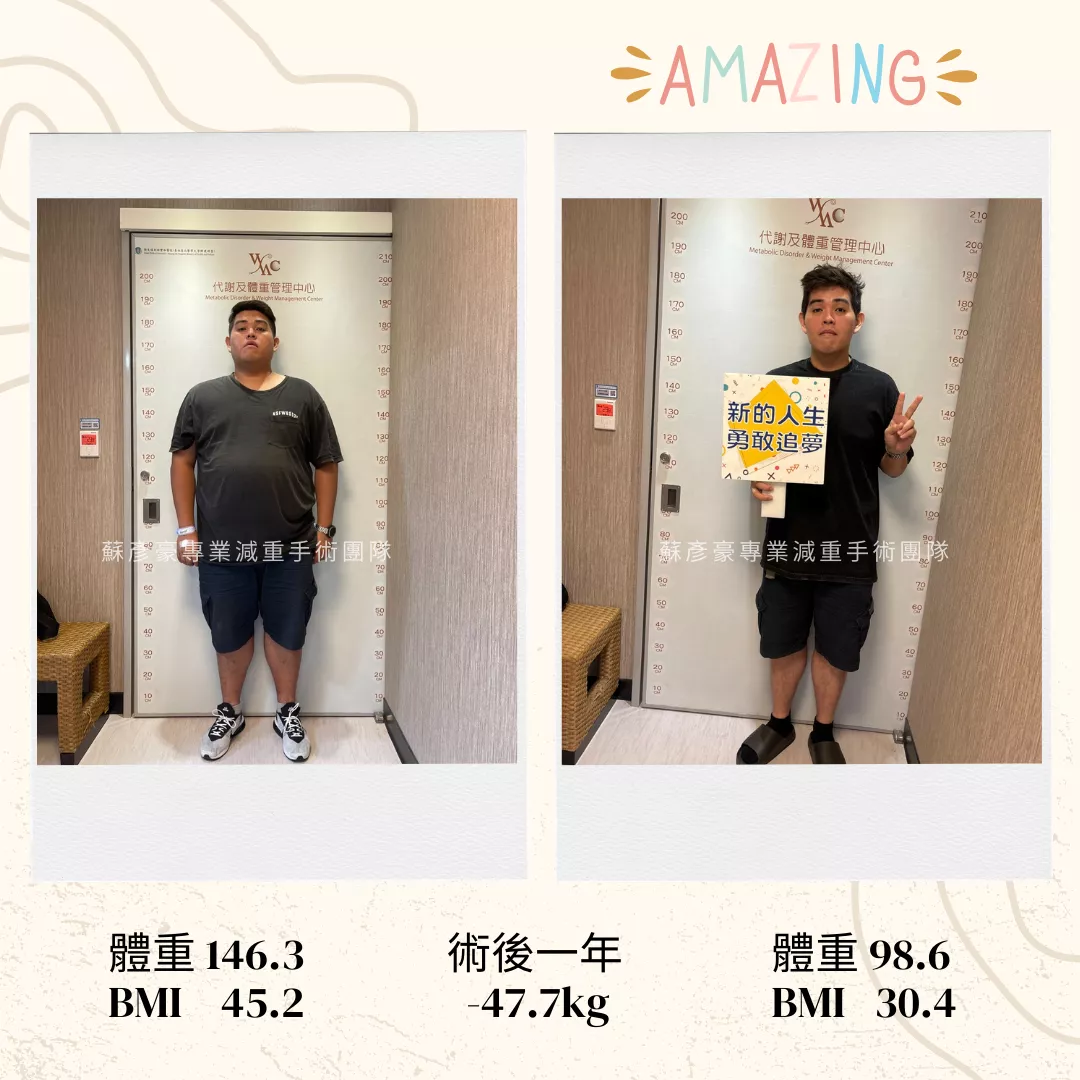 減重手術案例分享 俊勳