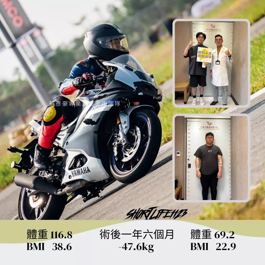 減重手術案例分享 晟瑞