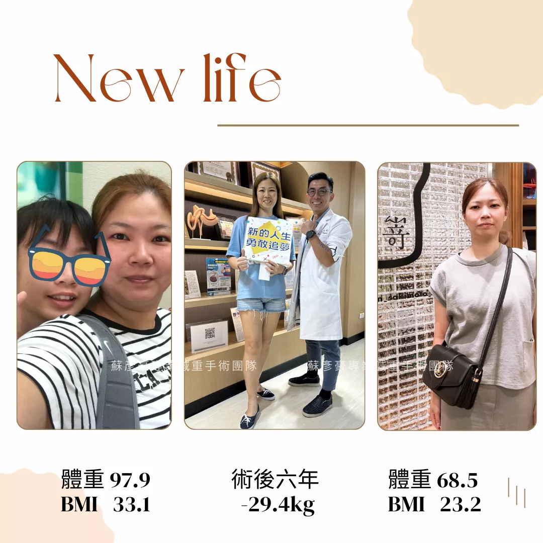 減重手術案例分享 芃妤