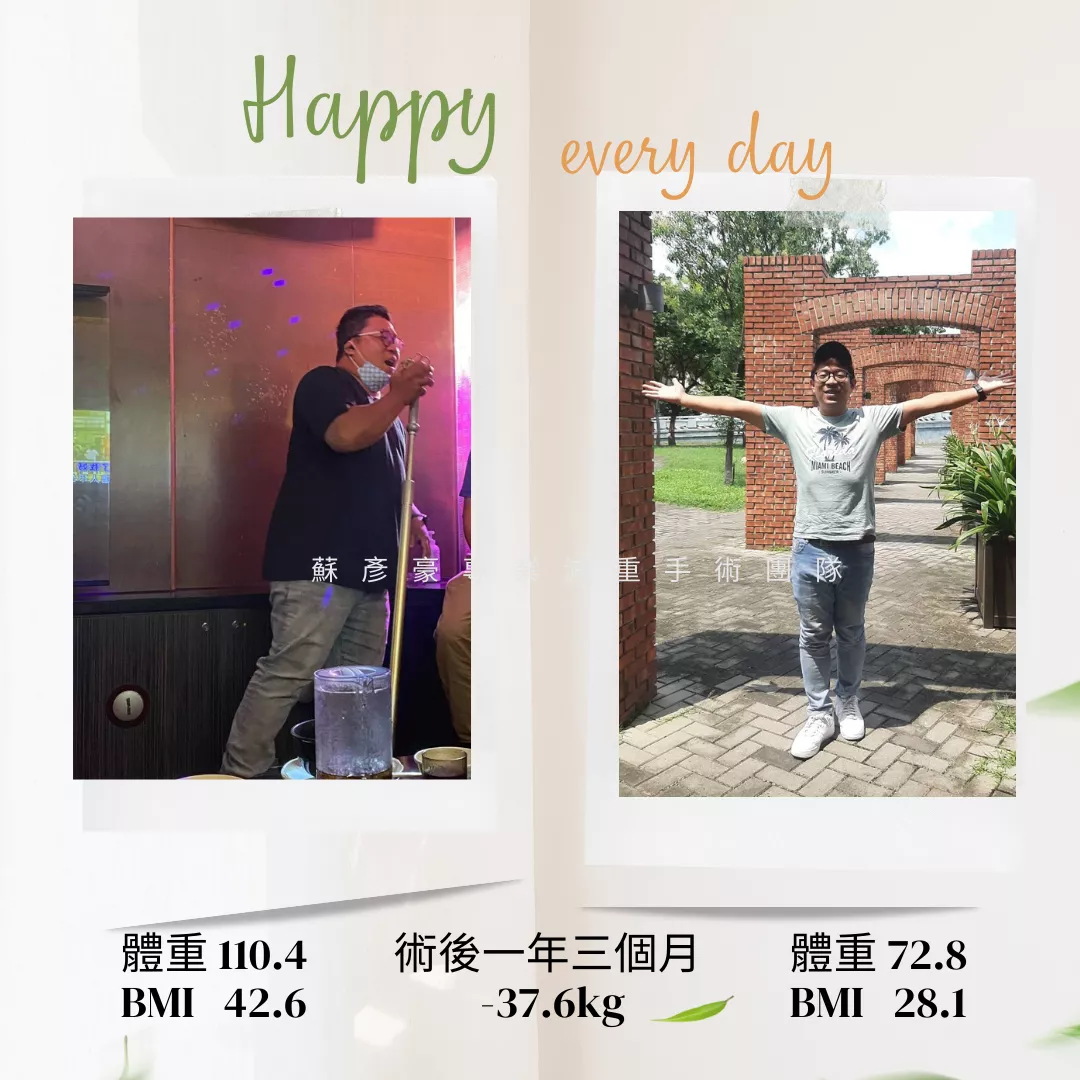 減重手術案例分享 濬莨